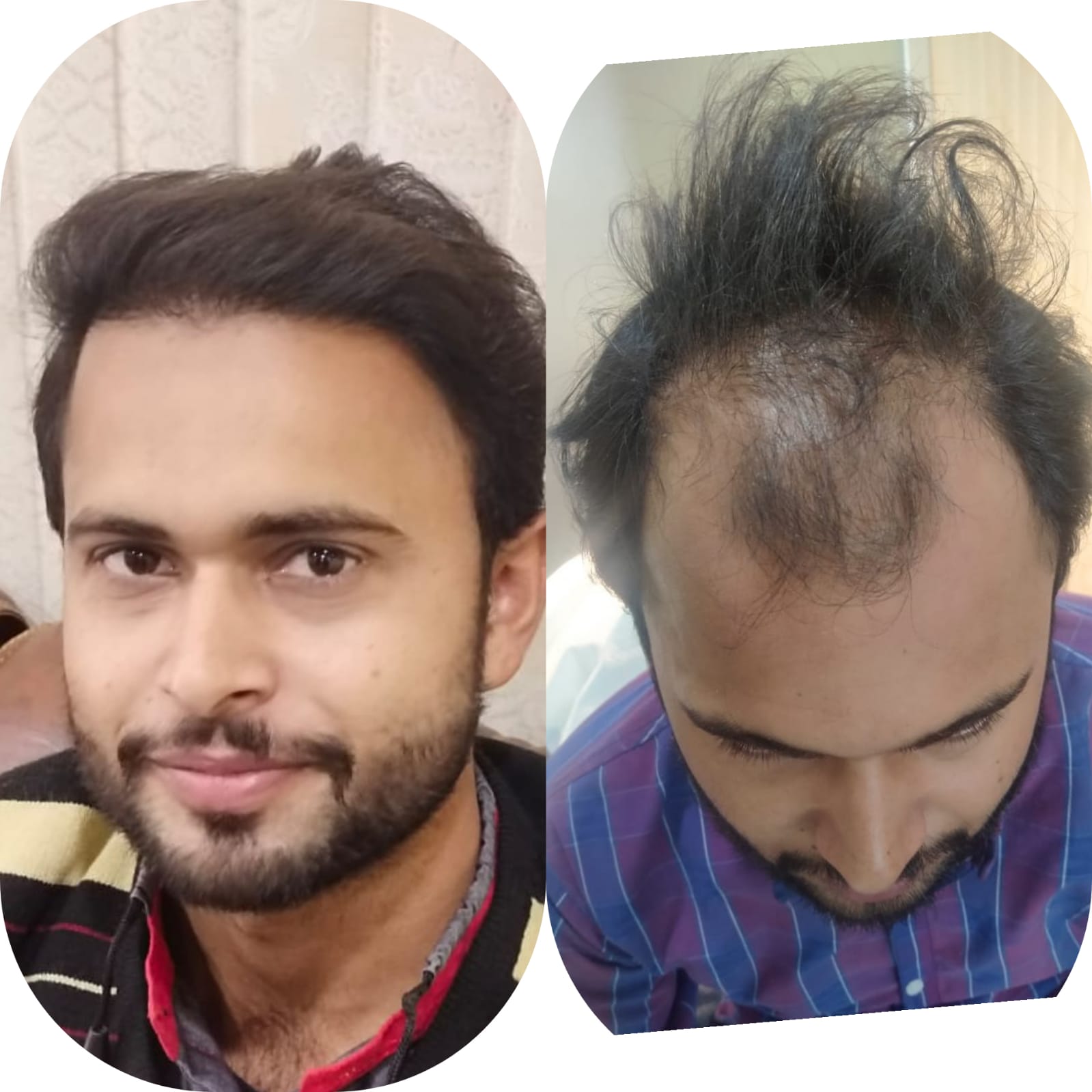 FUE Transplant Before
