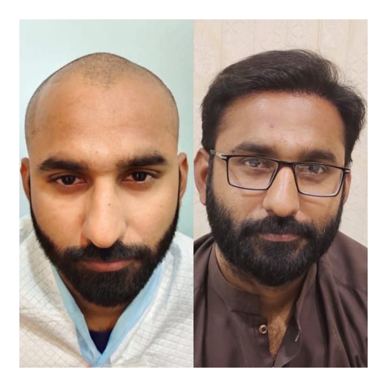 FUE Transplant Before