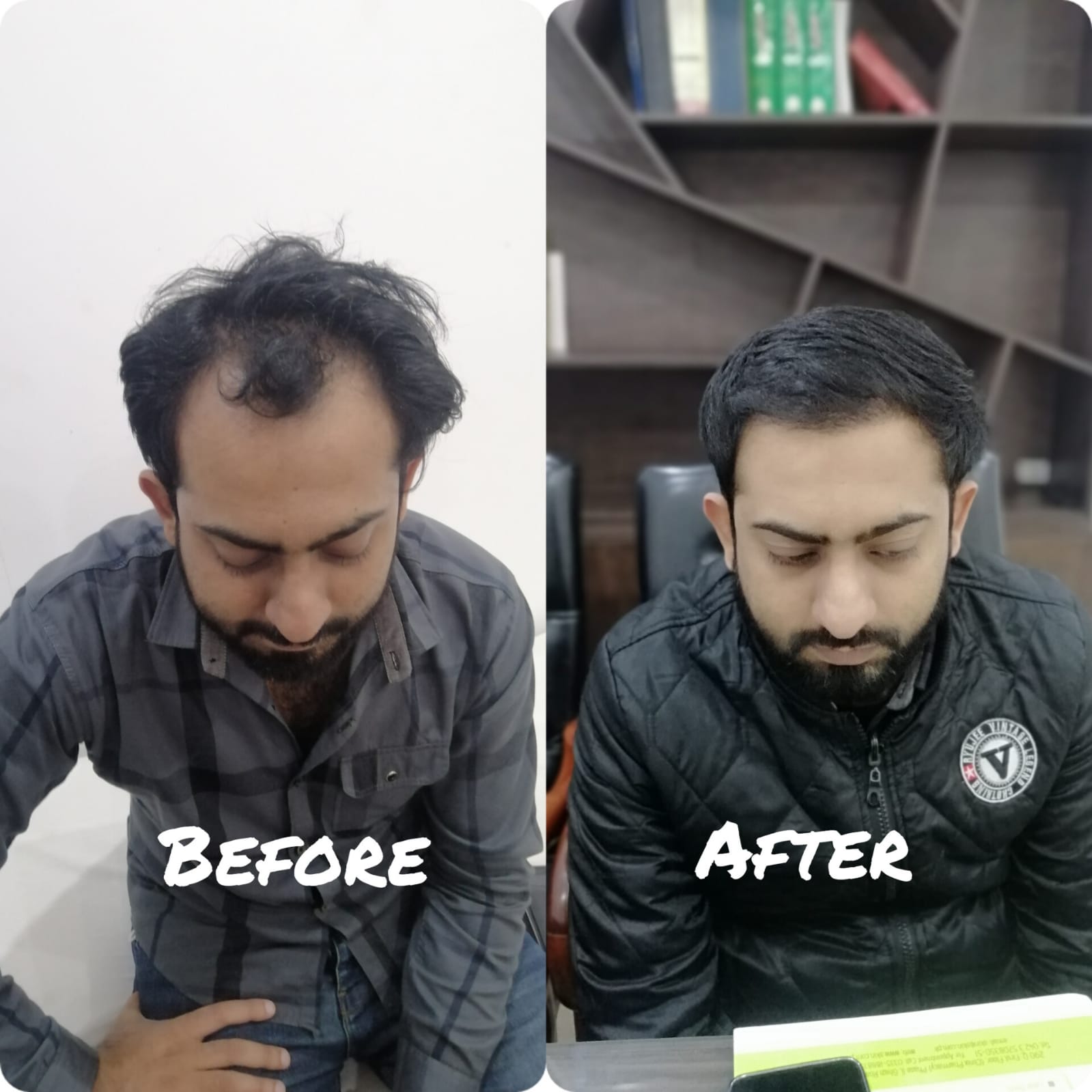 Beard Transplant Before