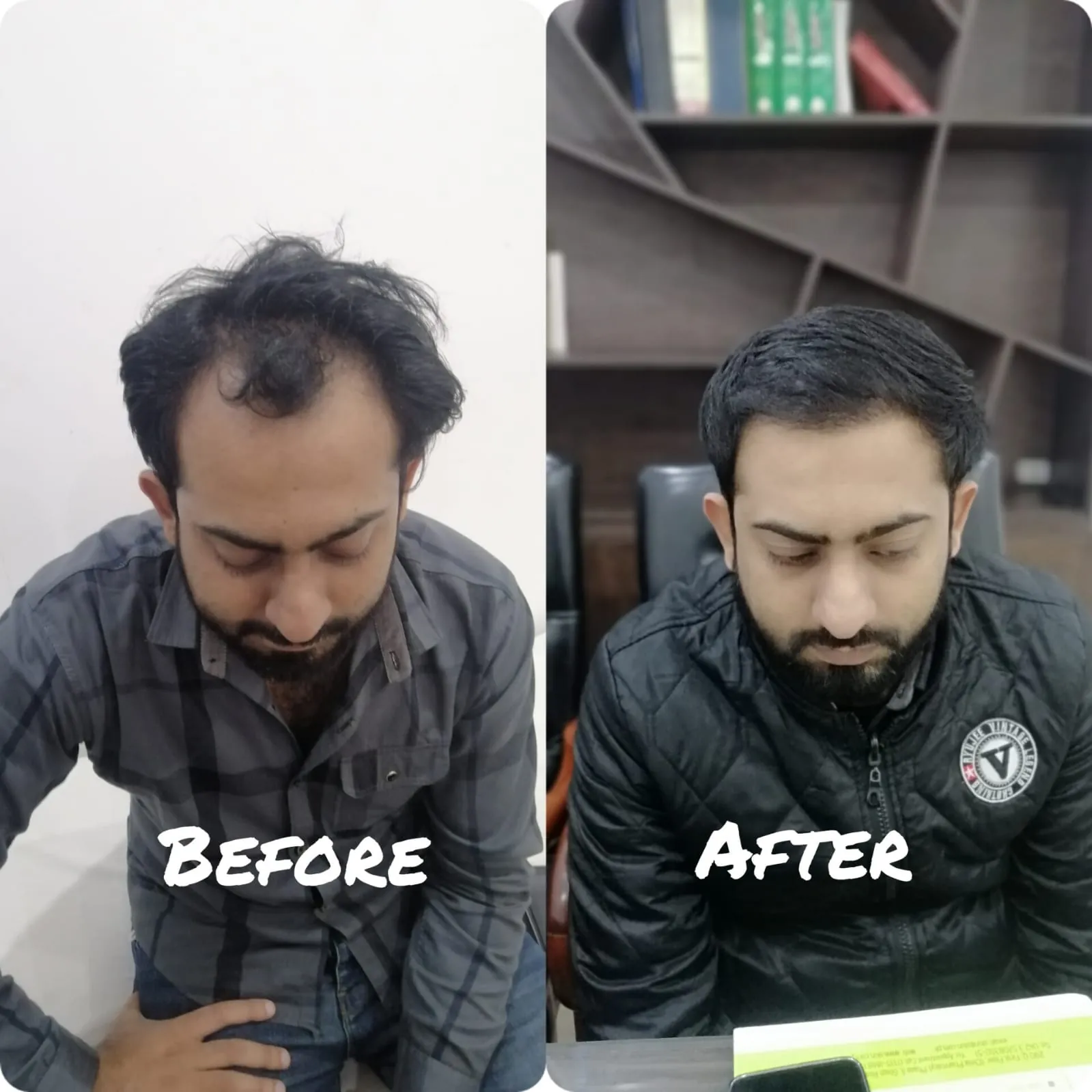 Beard Transplant Before