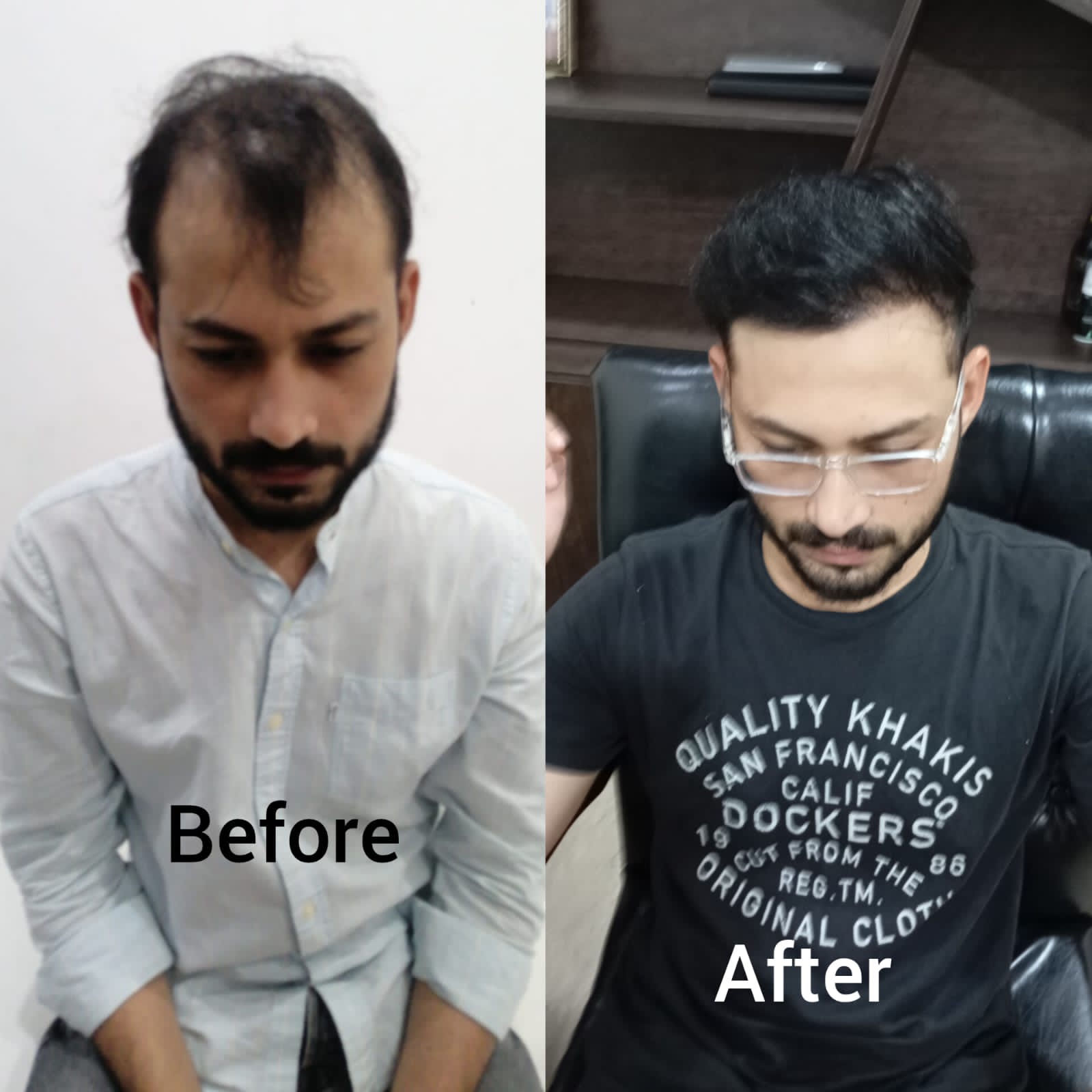 Hairline Restoration Before