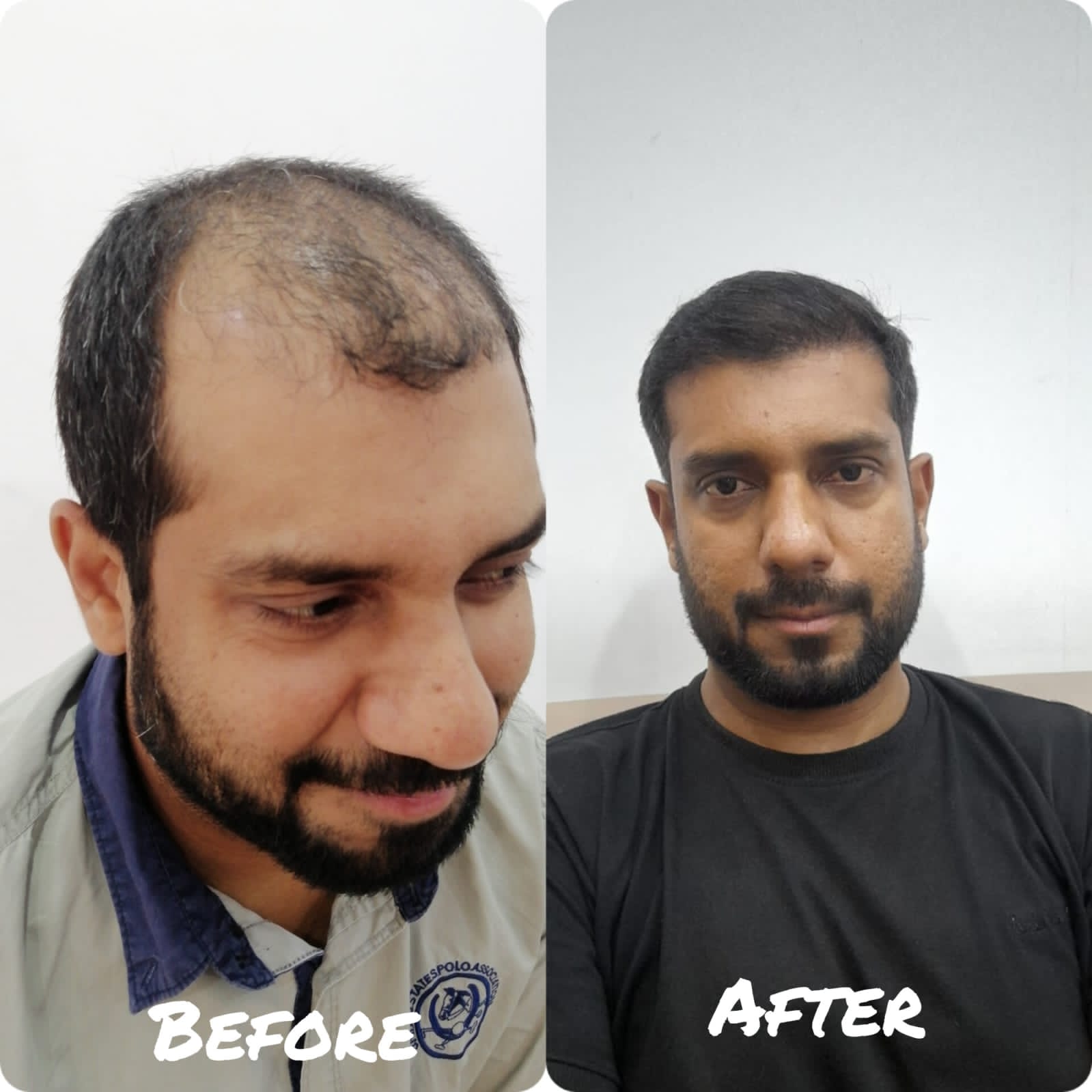 PRP Therapy Before